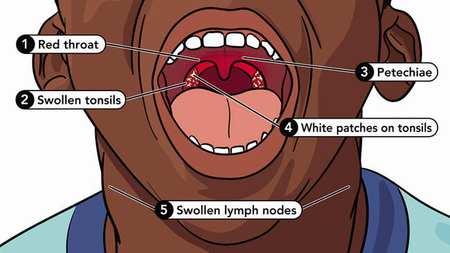 Child with open mouth showing red throat, white spots and signs of strep throat are labelled.